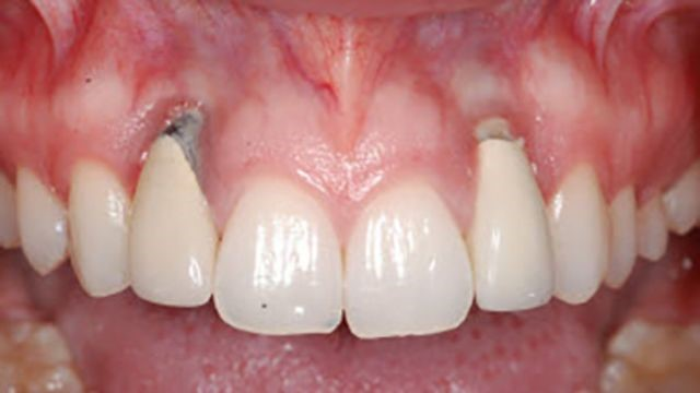 Răng Implant không bị sâu như răng tự nhiên, tuy vậy Implant vẫn có thể gặp các vấn đề nghiêm trọng khác
