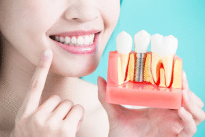 Ngày nay, kỹ thuật cắm Implant ngày càng phát triển giúp dễ dàng hơn trong việc cấy ghép Implant phù hợp nhiều độ tuổi khác nhau
