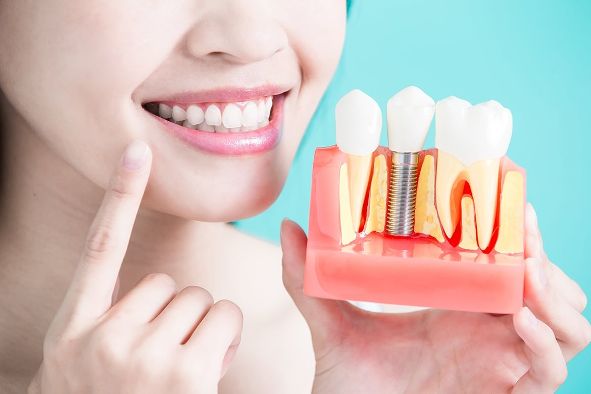 Ngày nay, kỹ thuật cắm Implant ngày càng phát triển giúp dễ dàng hơn trong việc cấy ghép Implant phù hợp nhiều độ tuổi khác nhau