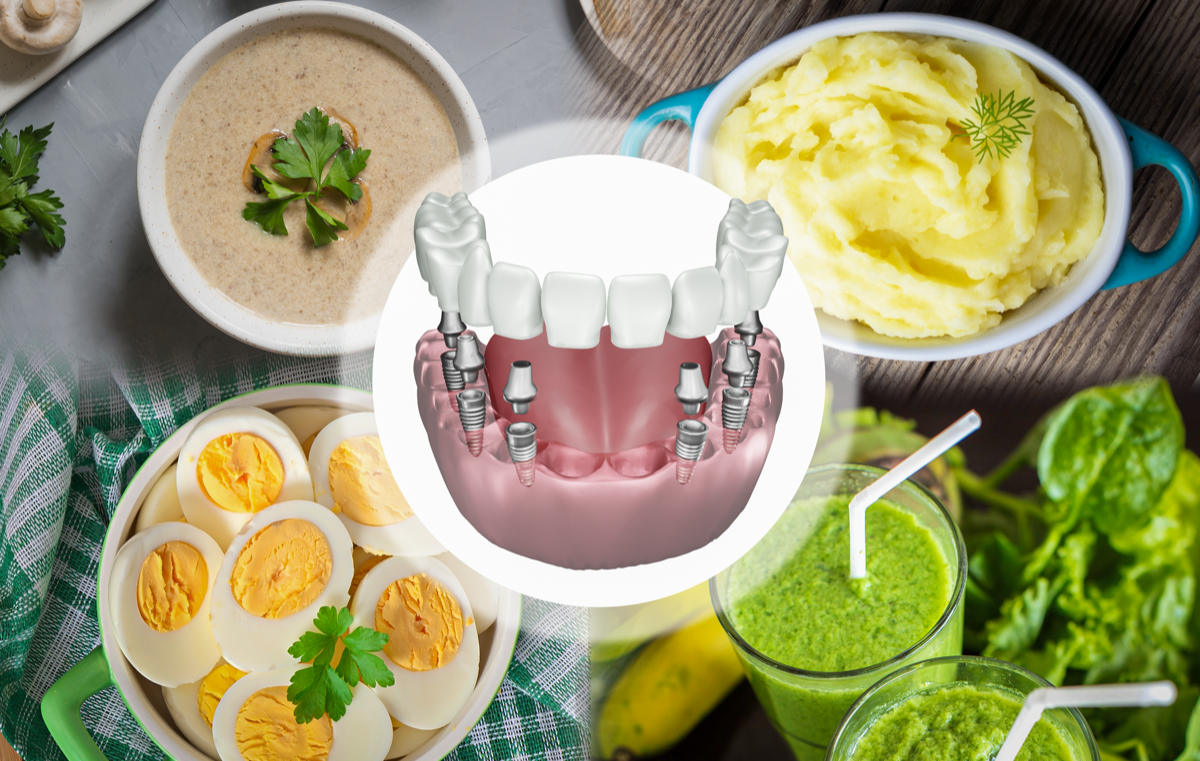 Chăm sóc Implant đúng cách không chỉ ngăn ngừa biến chứng mà còn giúp kéo dài tuổi thọ trụ lâu hơn