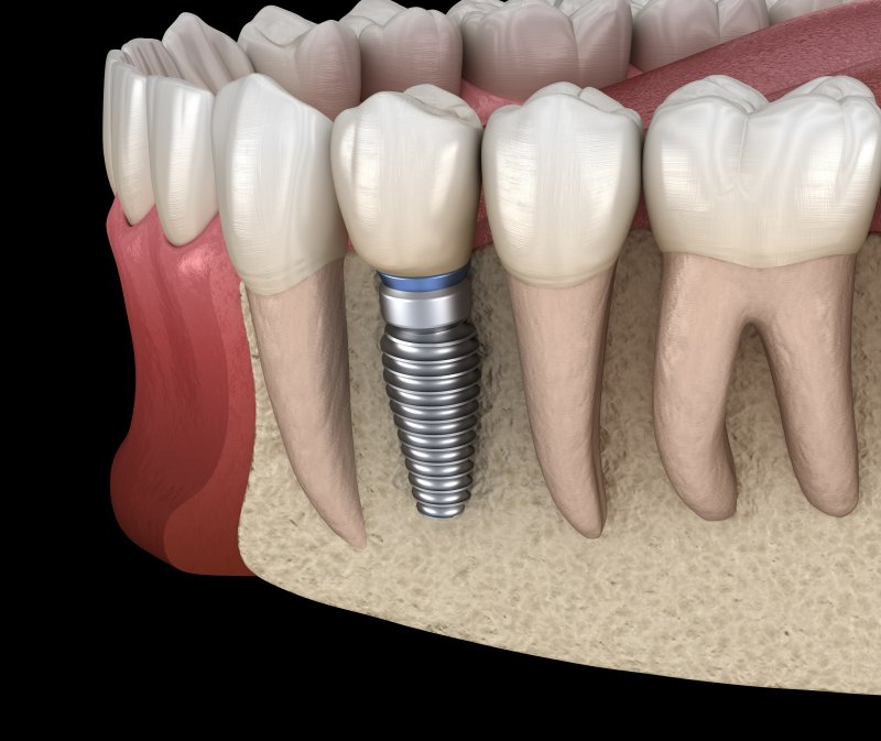 Cấy ghép Implant yêu cầu phải có mật độ xương hàm phù hợp 