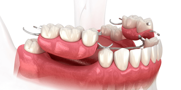 Có thể sử dụng hàm tháo lắp hoặc cầu răng sứ thay cho cấy ghép Implant khi chưa đủ điều kiện cấy ghép Implant 
