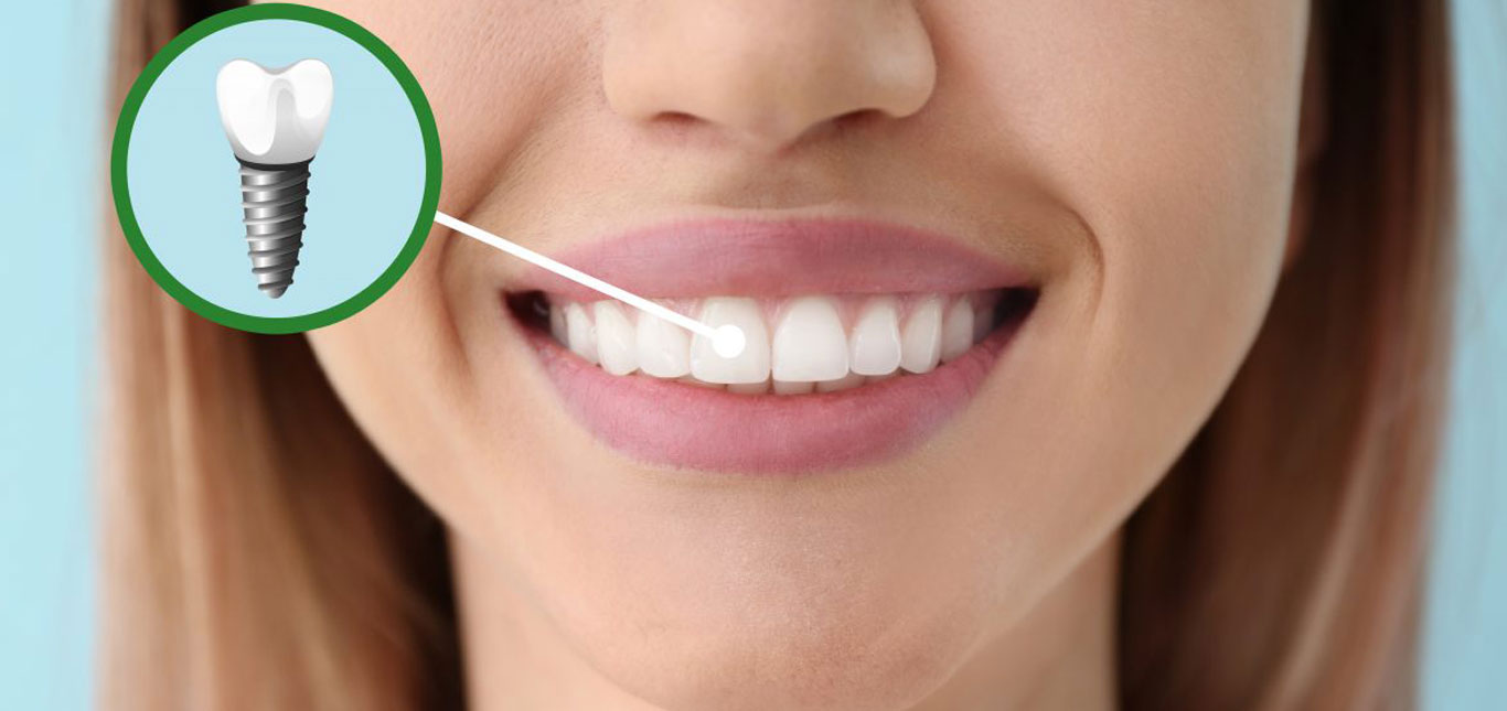 Ngoài độ tuổi, thói quen sống lành mạnh cũng quyết định bạn có thể cấy ghép Implant hay không